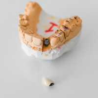 Сколько стоит имплантация зубов