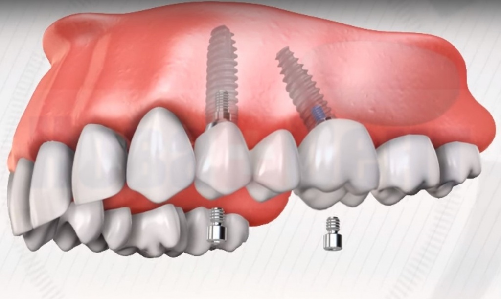 Имплантация на верхнюю челюсть