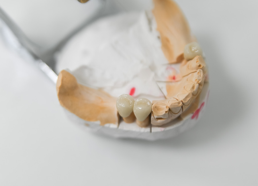 Восстановление зубов металлокерамикой