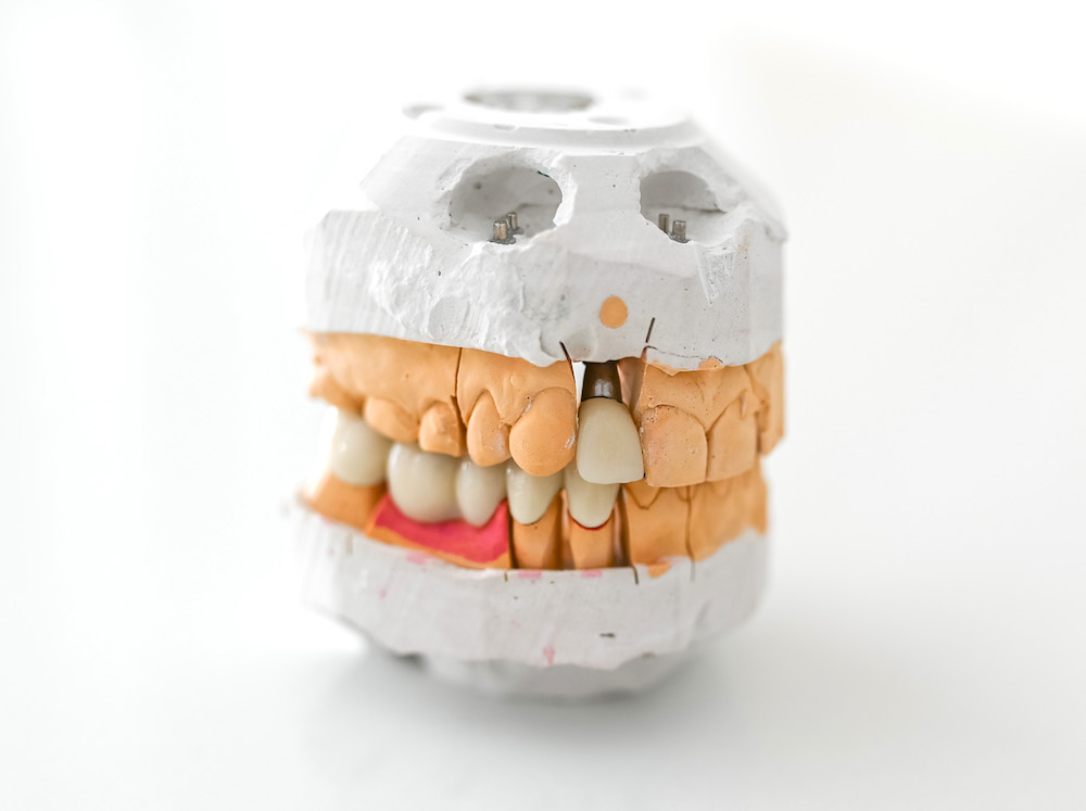 Протезирование переднего зуба