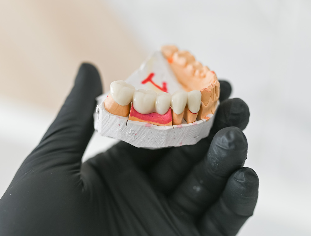 Мост на жевательные зубы выполненный из металлокерамики для пациента