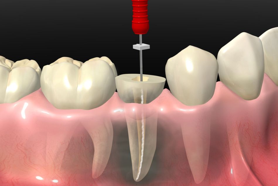 Пломбировка канала в стоматологии