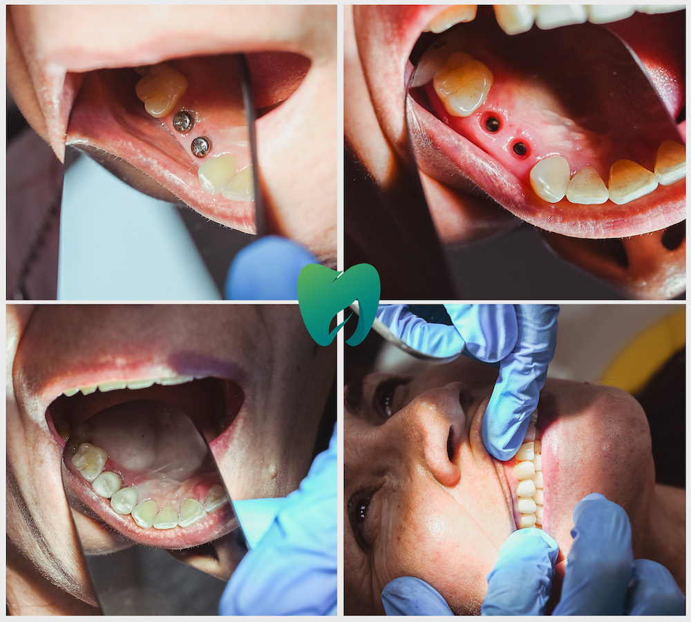 Имплантация зуба с коронкой