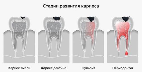 Стадии развития кариеса