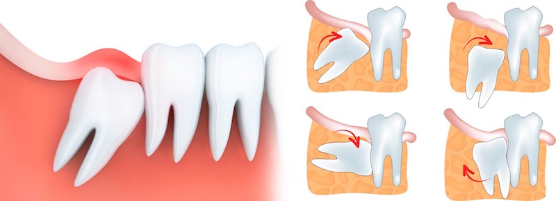 Причины удаление зуба мудрости